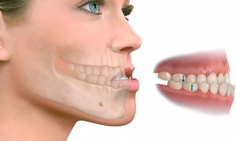 мезиальный прикус как аномалия развития нижней челюсти