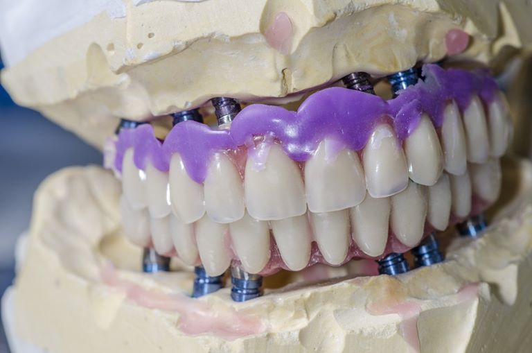 Реимплантация утерянных зубов