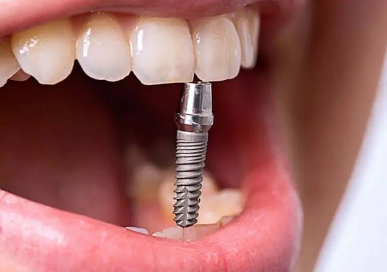 Методы имплантации при замене зубов