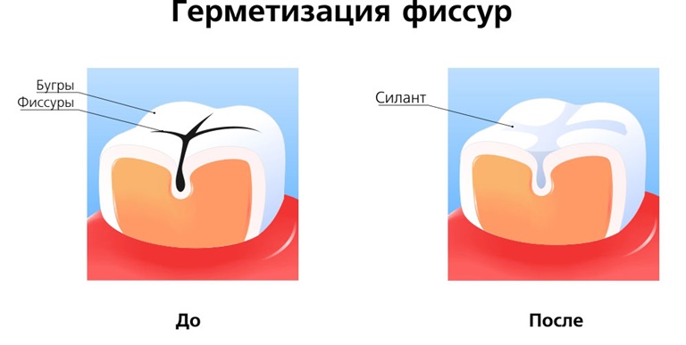 суть герметизации фиссур зубов