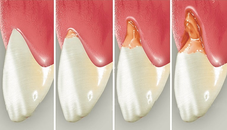 причины появления клиновидного дефекта зубов