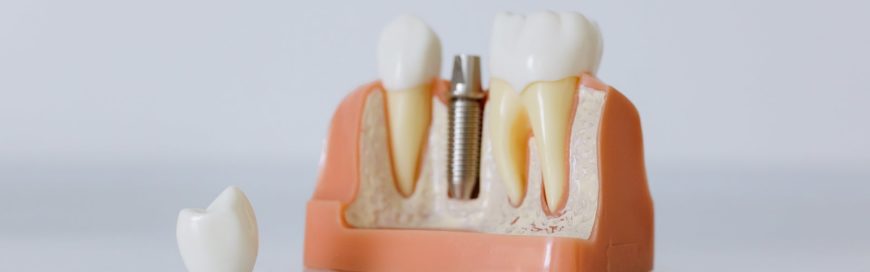Имплантация зубов – плюсы и минусы процедуры