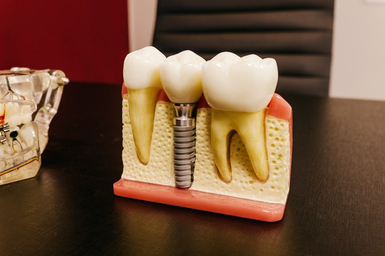 показания и противопоказания для имплантации зубов