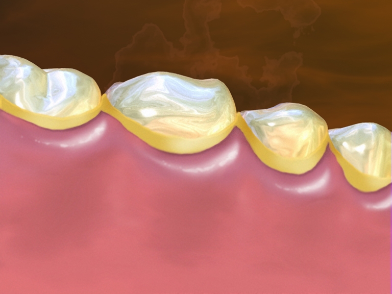 причины и механизм развития зубной бляшки