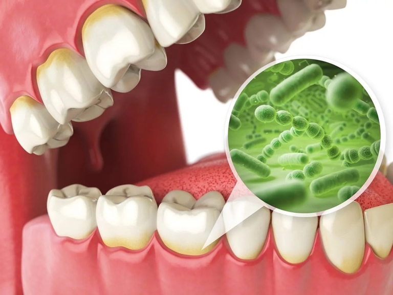 причины и механизм развития зубной бляшки
