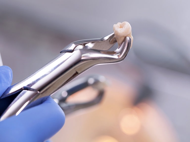 что собой представляет процедура удаления зуба