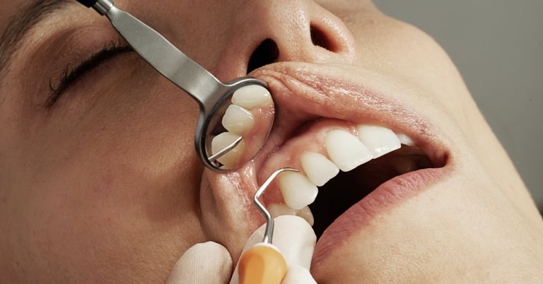 что такое рак зубов