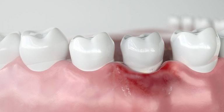 виды рака зубов