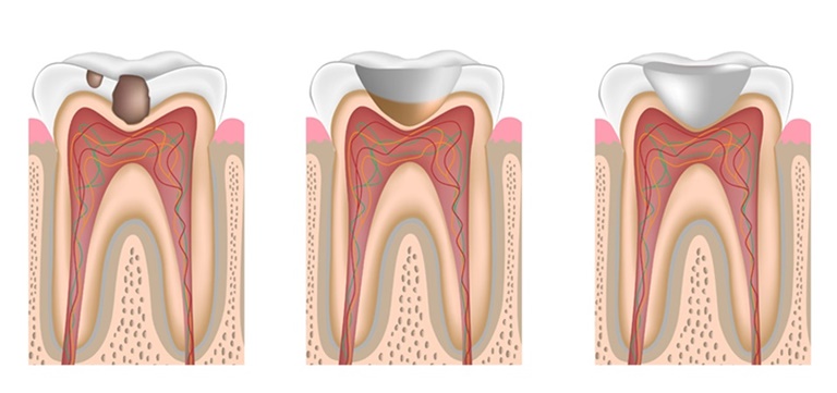 процесс пломбирования зубов
