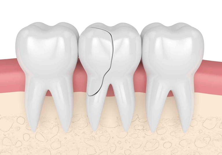 классификация трещин зуба