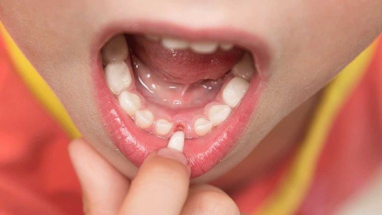 можно ли самостоятельно понять, что у ребенка вывих зуба