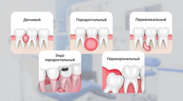 виды и стадии абсцесса зуба