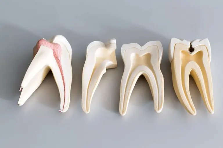 Как предупредить проблему крошения зубов?