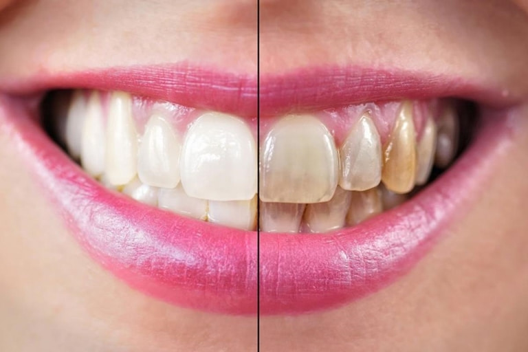 Можно ли отбелить тетрациклиновые зубы