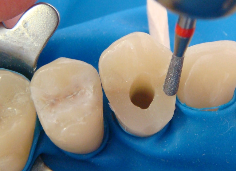 сколько может прожить зуб после пульпотомии