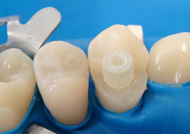 стекловолоконный штифт в реставрации зуба