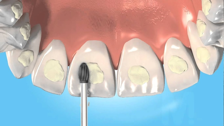что такое адгезив в стоматологии
