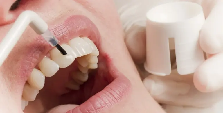 особенности фторирования зубов