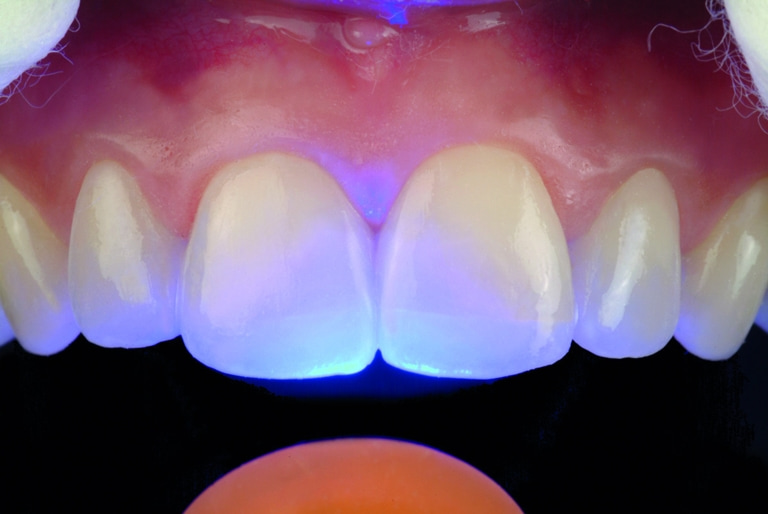 назначение композитов в стоматологии