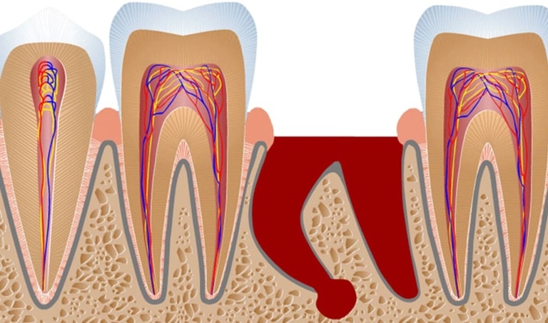состояние лунки после удаления зуба