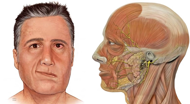 что такое невралгия лицевого нерва