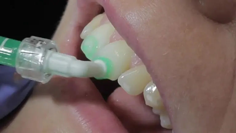показания к фторированию зубов