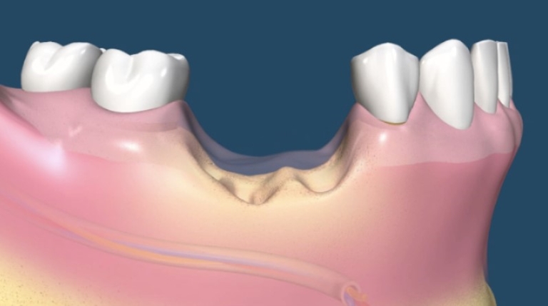 процесс заживления тканей десны после удаления зуба