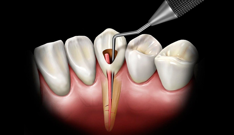 лечение перфорации зуба