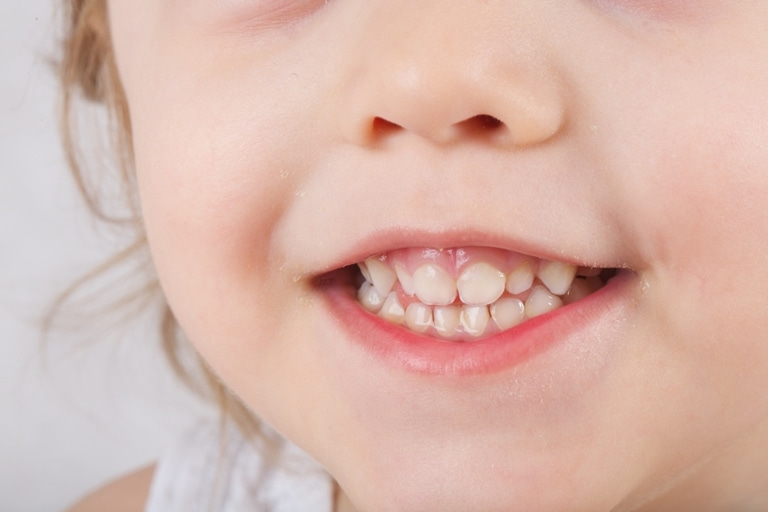 у кого чаще встречаются флюорозные зубы