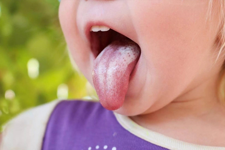 причины желтого налета на языке у ребенка
