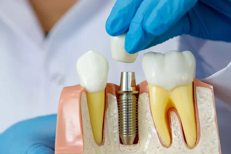 сколько стоит имплантация зубов под ключ