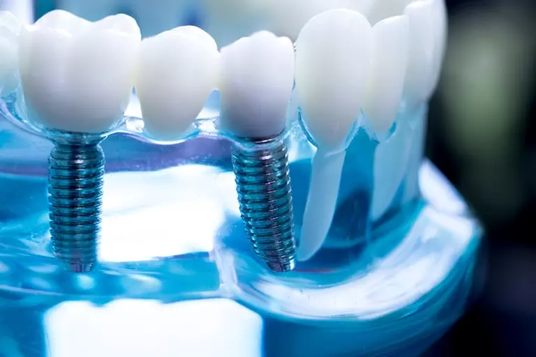 показания и противопоказания к имплантации зубов