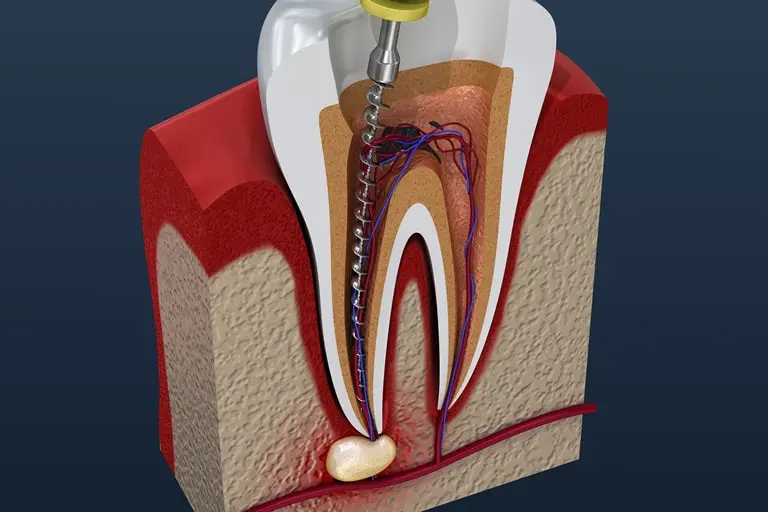 cколько длится чистка канала в зубе