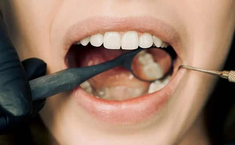 пульпит как стоматологическое заболевание