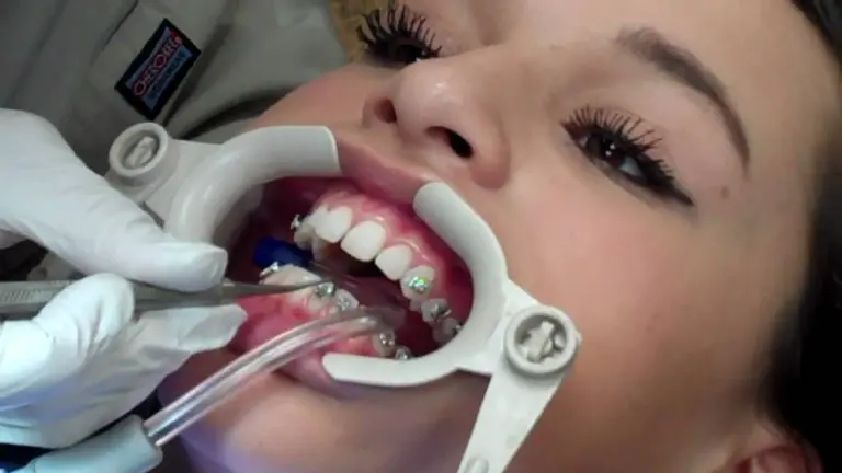 зубы после снятия брекетов
