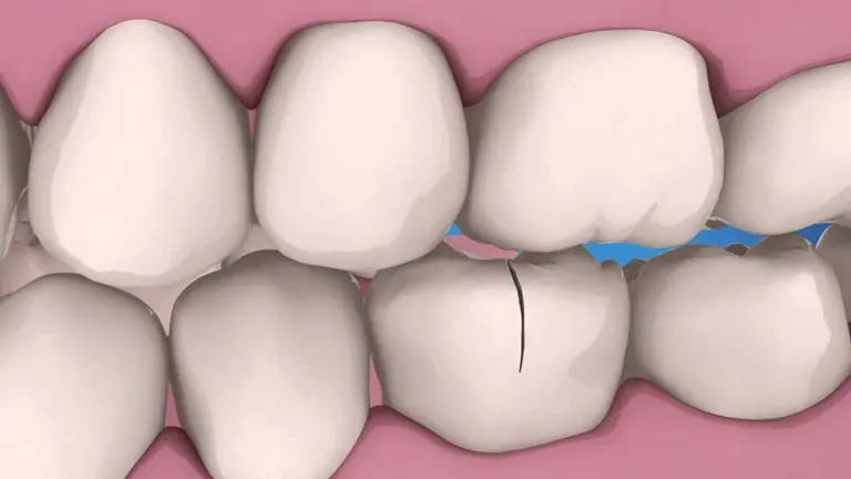 симптомы наличия трещины на зубе