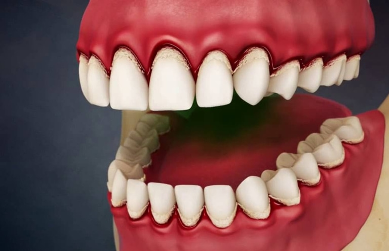 можно ли удалить зуб при наличии гипертрофического гингивита