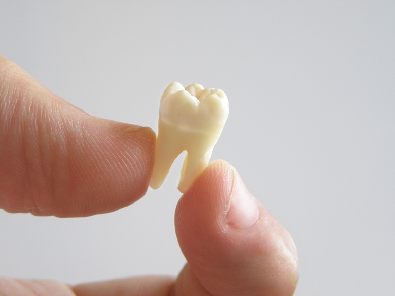 Возможные последствия сверхкомплектных зубов