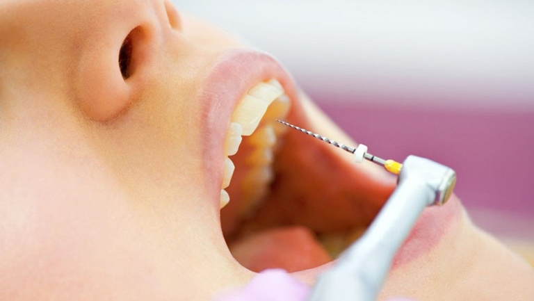 этапы удаления зубного нерва