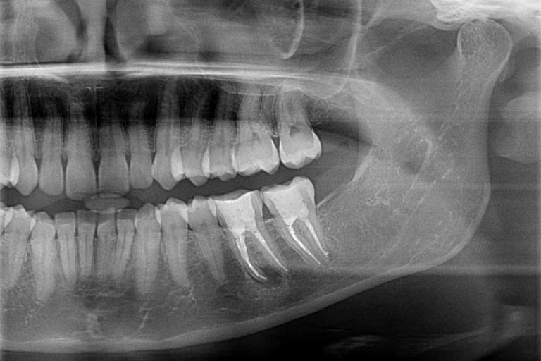 диагностика кисты на корне зуба