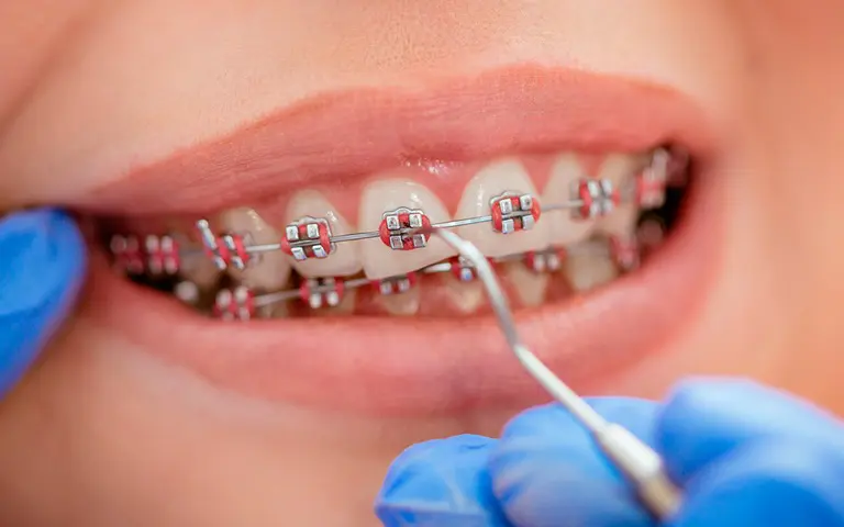 Подвижность зубов при ношении брекетов