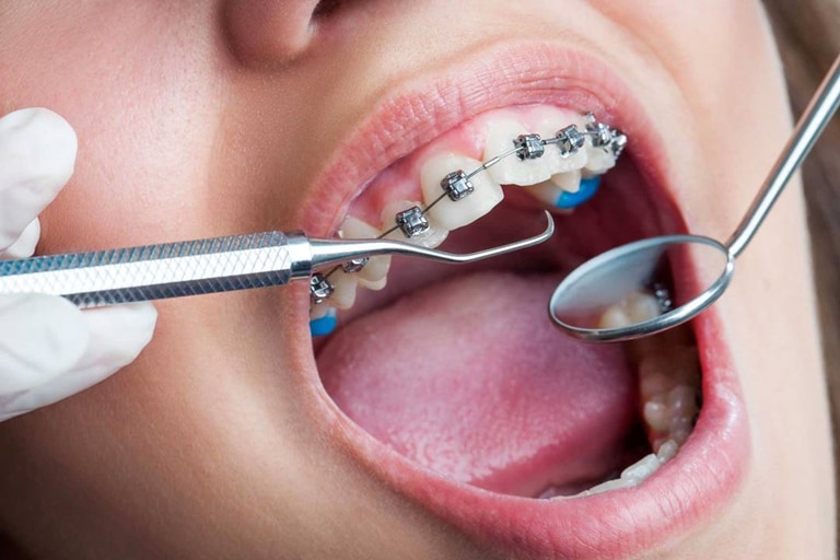 сколько болят зубы после установки брекетов