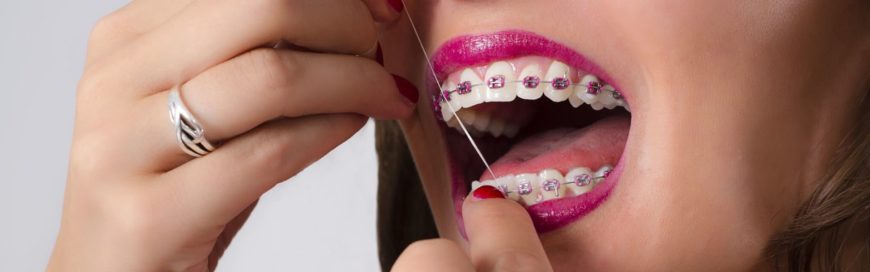 Зубы после брекетов: возможные осложнения и способы их решения
