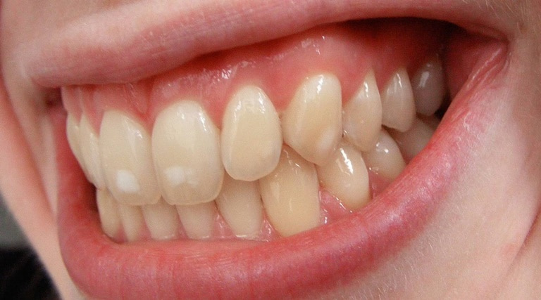 что такое эрозия эмали зубов