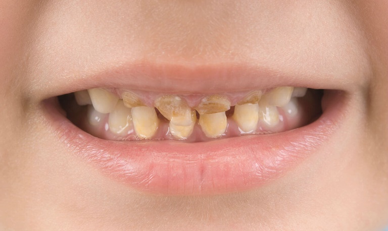 что такое гипоплазия молочных зубов