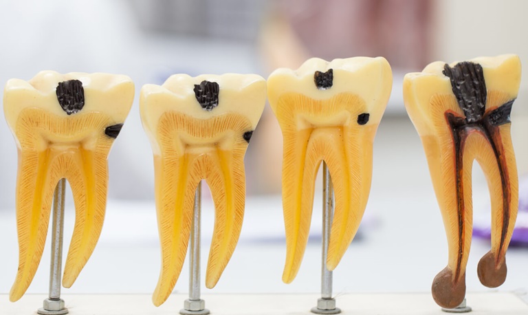причины возникновения кариеса корня зуба