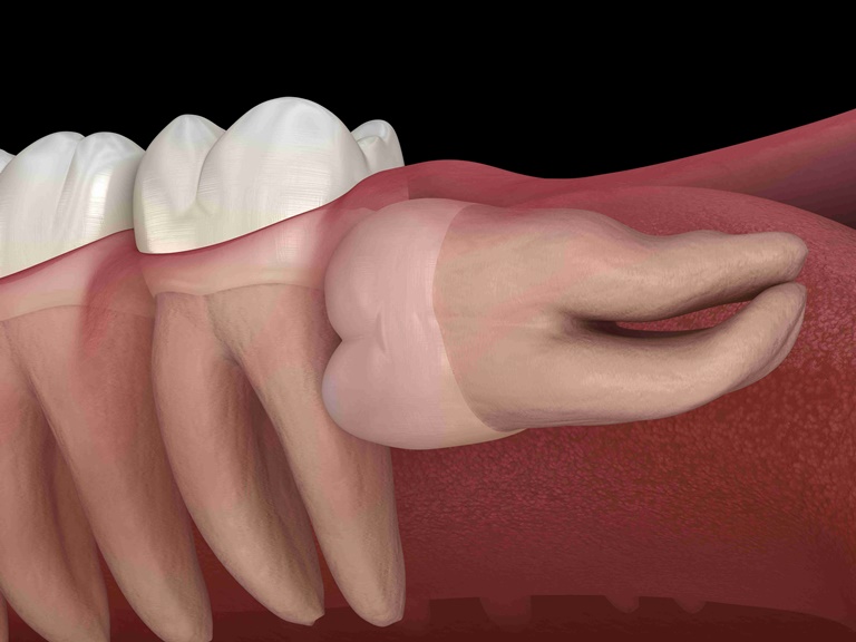 причины возникновения лежачего зуба