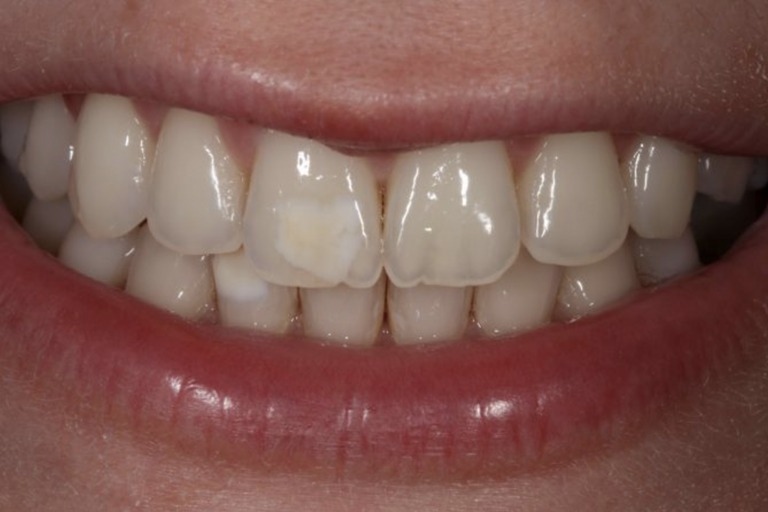 местная гипоплазия эмали зуба
