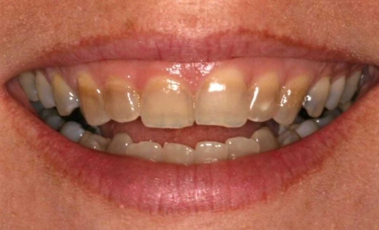 причины развития гипоплазии эмали зубов