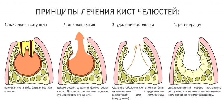лечение кисты челюсти
